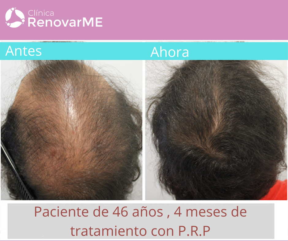 TRATAMIENTO PARA LA ALOPECIA , CAIDA DEL CABELLO, MINOXIDIL, CLINICARENOVARME.COM