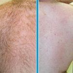 Depilación laser en espalda
