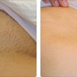 Depilación Laser are bikine