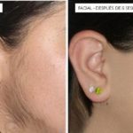 Depilación laser en el rostro