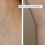 Depilación laser en axilas