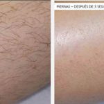 Depilación laser en piernas
