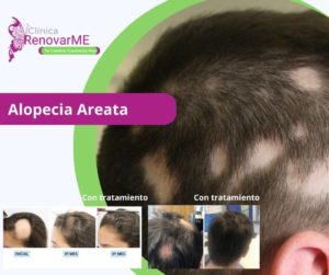 alopecia areata, alopecia androgenica, alopecia difusa, tratamiento para la alopecia, caida del cabello. clinica renovarme 2