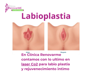 tratamiento laser co2, tratamiento intimo co2 fraccionado, labio plastia, aclaramiento vaginal, tratamiento inconsistencia urinaria, verrugas genitales,ginecologia, clinica renovarme, costa rica 15