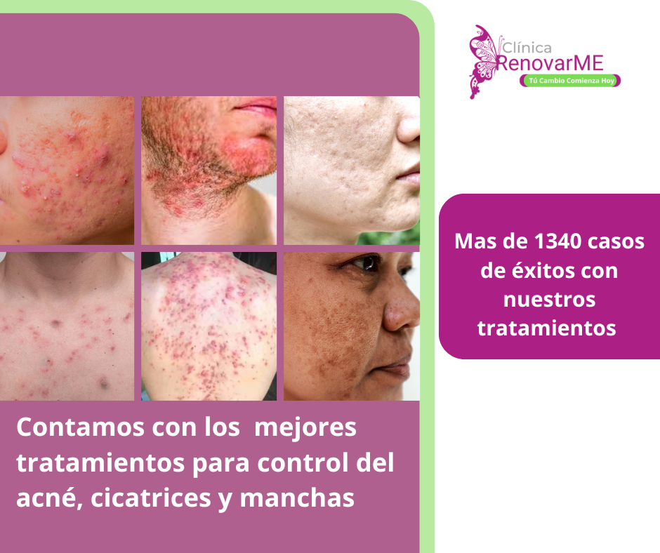 tratamientos para el acne, tratamientos manchas de acné, tratamientos manchas de cicatrices de acne