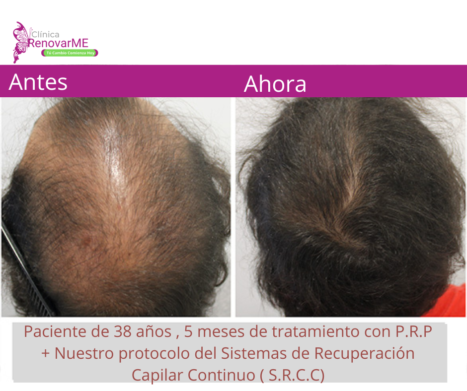 tratamientos para la alopecia, caida del cabello en costa rica, doctores tricologos clinica renovarme ,clinica el pelo, capilea (1)