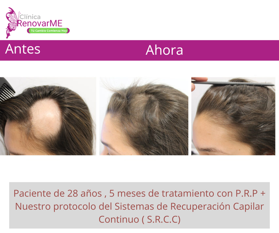 tratamientos para la alopecia, caida del cabello en costa rica, doctores tricologos clinica renovarme ,clinica el pelo, capilea (10)