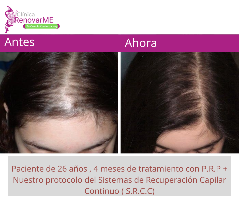 tratamientos para la alopecia, caida del cabello en costa rica, doctores tricologos clinica renovarme ,clinica el pelo, capilea (11)
