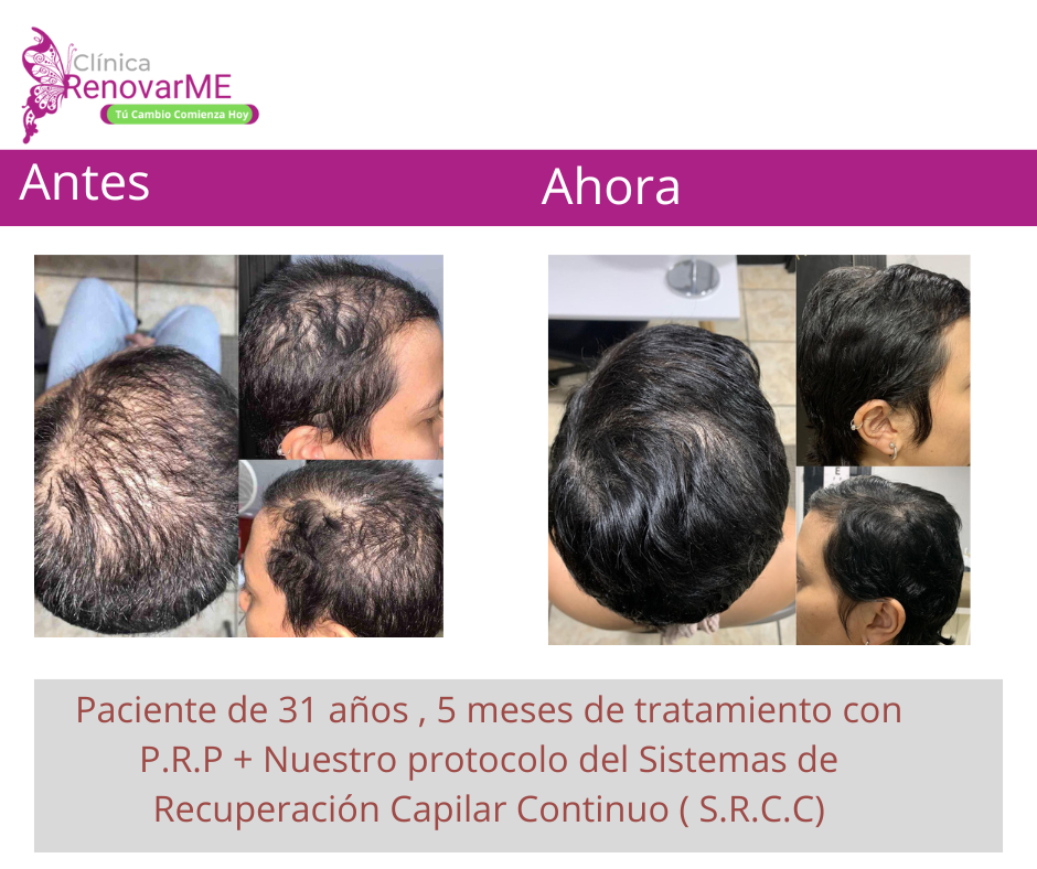 tratamientos para la alopecia, caida del cabello en costa rica, doctores tricologos clinica renovarme ,clinica el pelo, capilea (12)