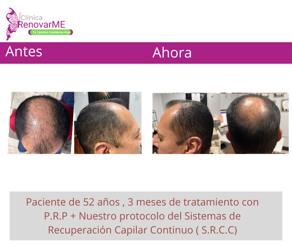 tratamientos para la alopecia, caida del cabello en costa rica, doctores tricologos clinica renovarme ,clinica el pelo, capilea (13)