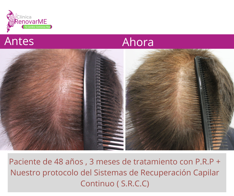 tratamientos para la alopecia, caida del cabello en costa rica, doctores tricologos clinica renovarme ,clinica el pelo, capilea (2)