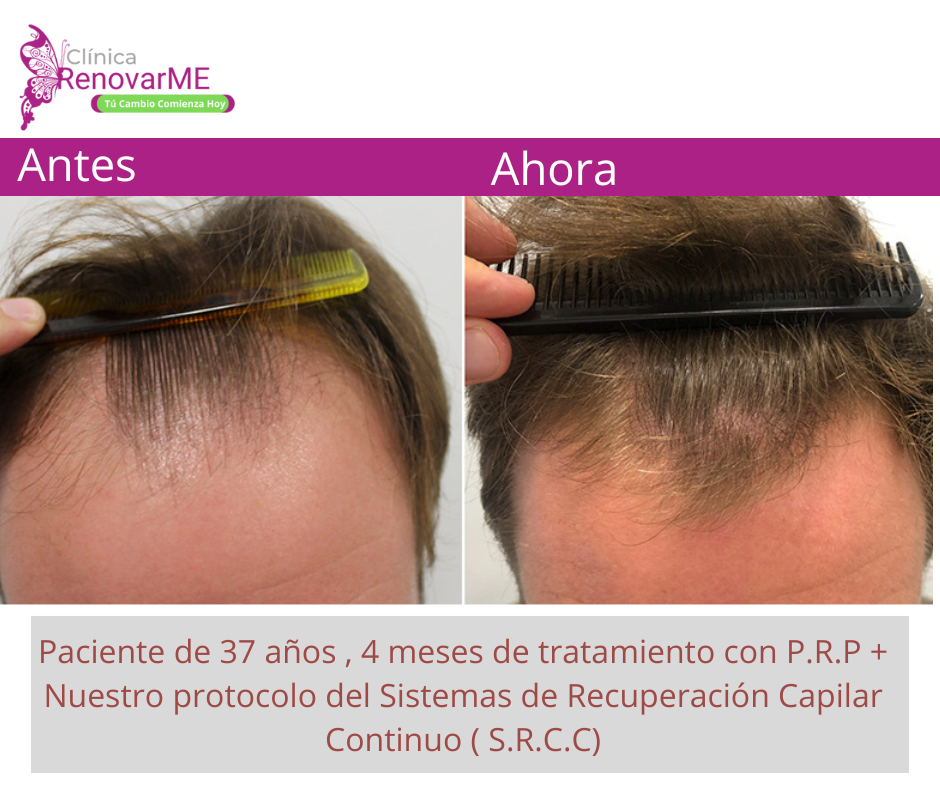 tratamientos para la alopecia, caida del cabello en costa rica, doctores tricologos clinica renovarme ,clinica el pelo, capilea (4)