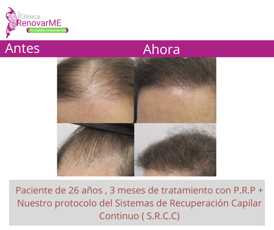 tratamientos para la alopecia, caida del cabello en costa rica, doctores tricologos clinica renovarme ,clinica el pelo, capilea (5)