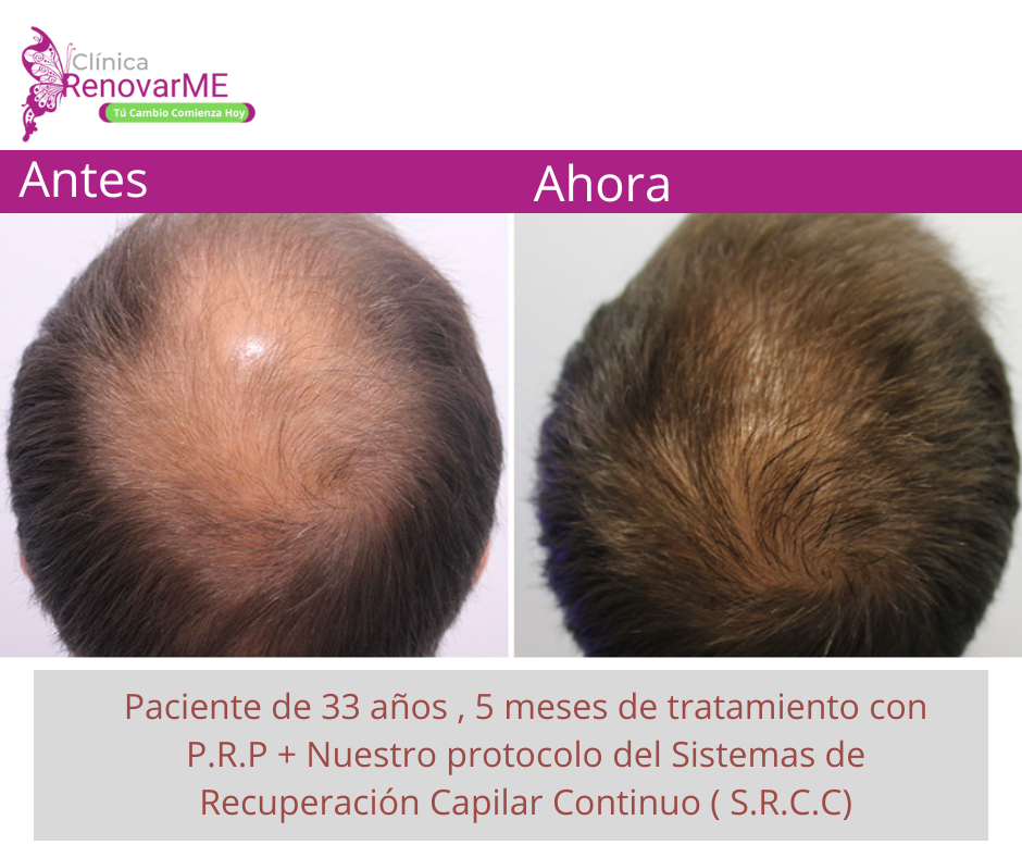 tratamientos para la alopecia, caida del cabello en costa rica, doctores tricologos clinica renovarme ,clinica el pelo, capilea (6)