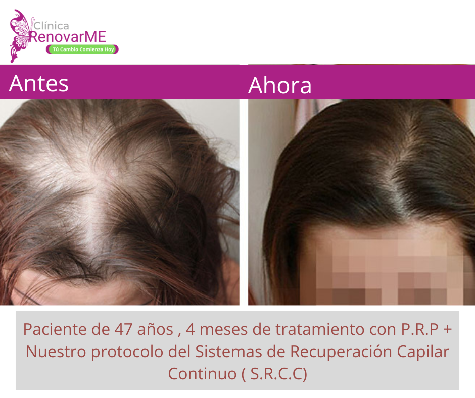 tratamientos para la alopecia, caida del cabello en costa rica, doctores tricologos clinica renovarme ,clinica el pelo, capilea (8)