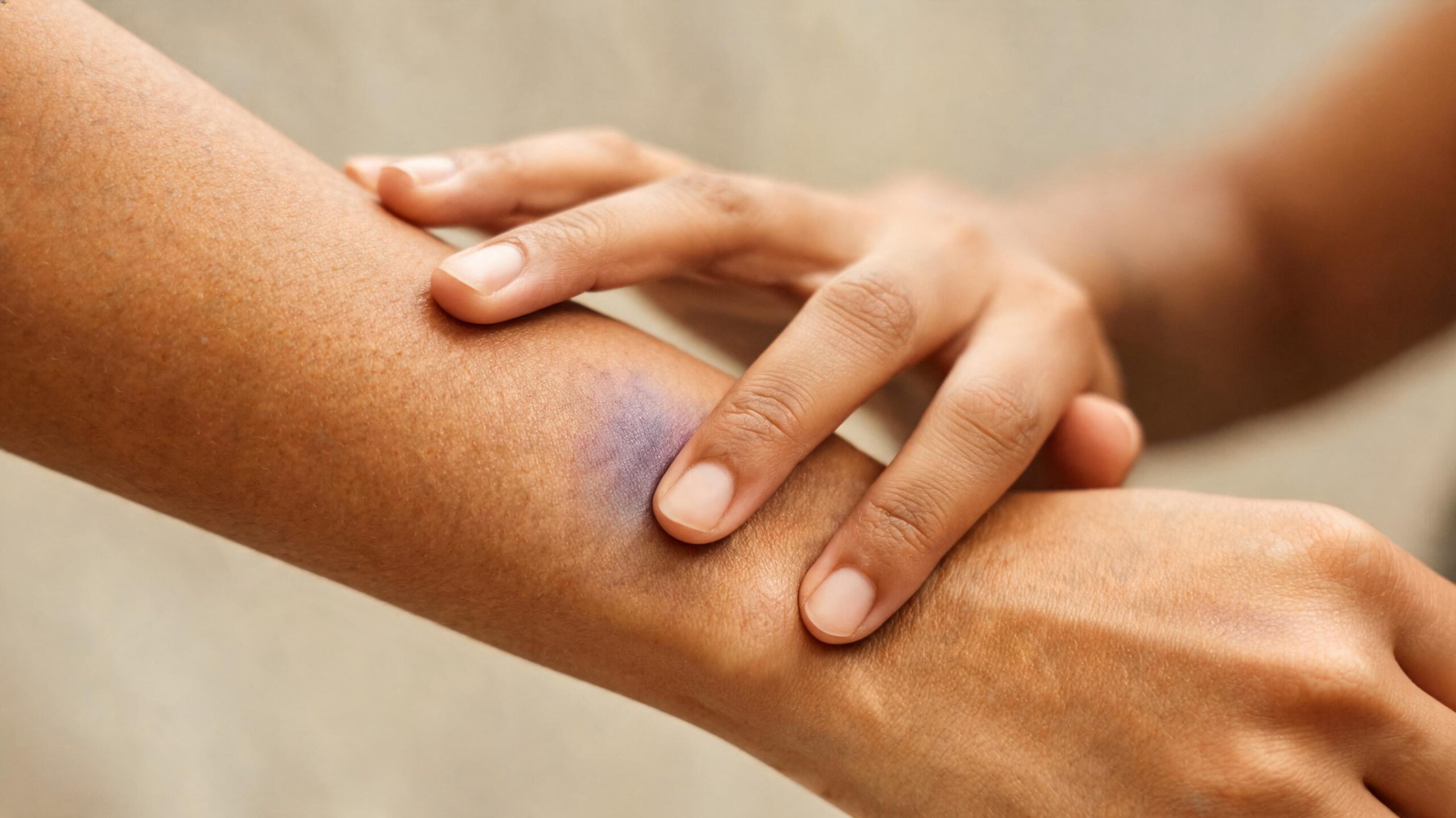 ¿Por qué algunas personas forman moretones o edema con más facilidad?