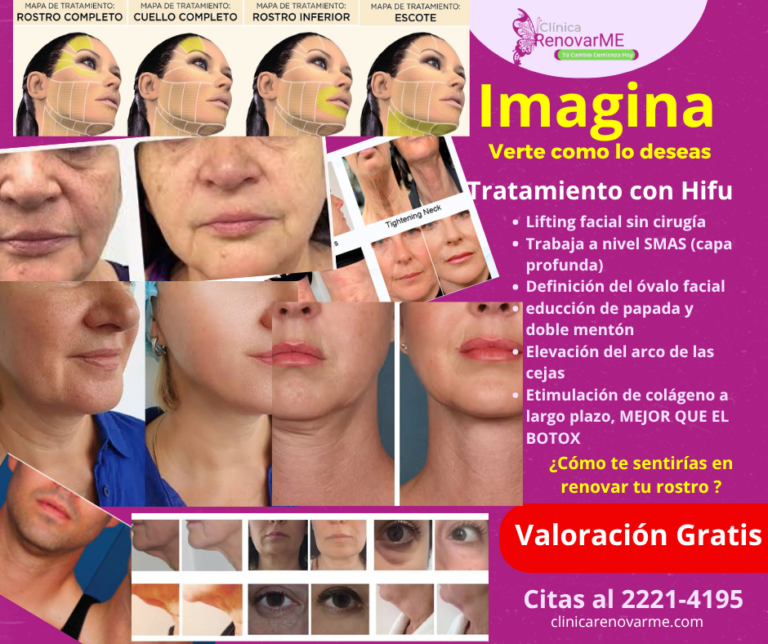 tratamientos faciales CON HIFU- tratamientos faciales - tratamiento de la papada- tratamientos rejuvenecedor facial- clinicas de estetoiica costa rica